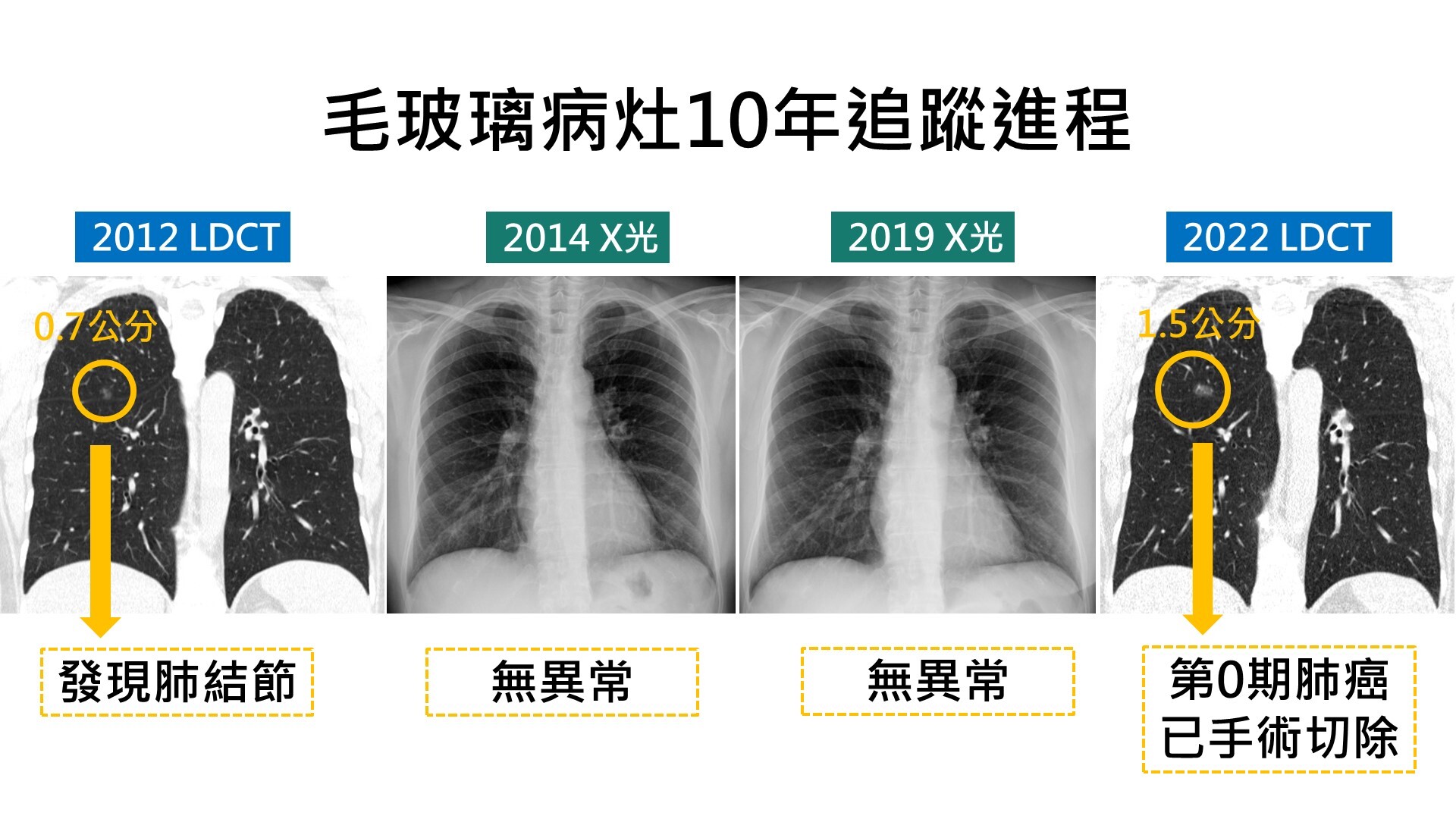 ▲10年X光未發現！男子LDCT檢查揪出肺癌　醫師提醒：五種症狀就要當心