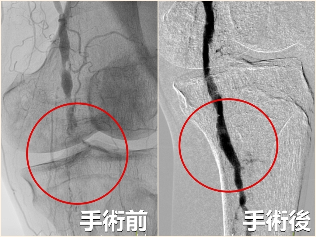 ▲不是退化！老翁嘆「天冷走路就會痛」 竟是周邊動脈全部阻塞了　醫籲：當心3徵兆